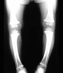 Raşitizm-Neden-Olur