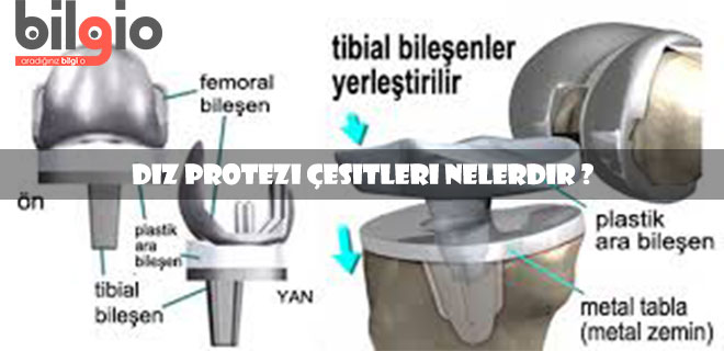 diz-protezi-çeşitleri