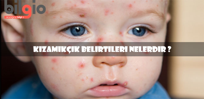 kızamıkçık-belirtileri