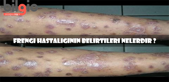frengi-belirtileri