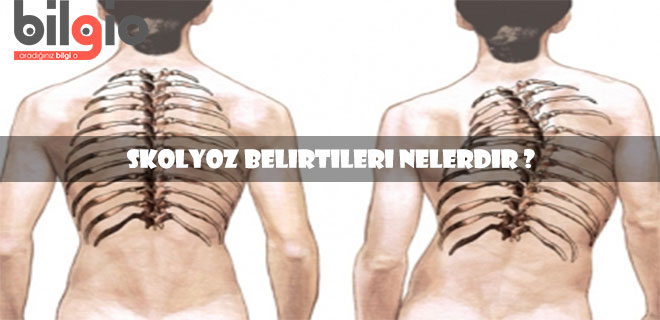 skolyoz-belirtileri