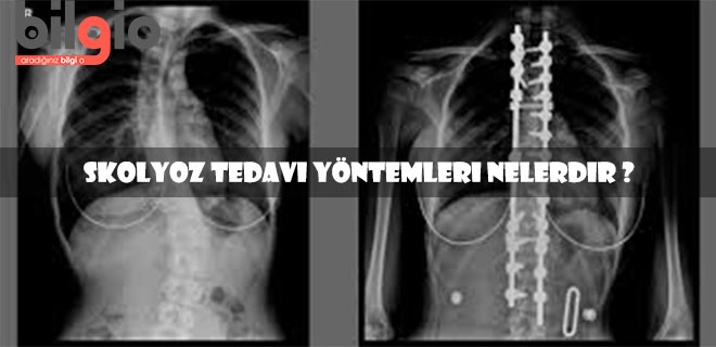 skolyoz-tedavisi